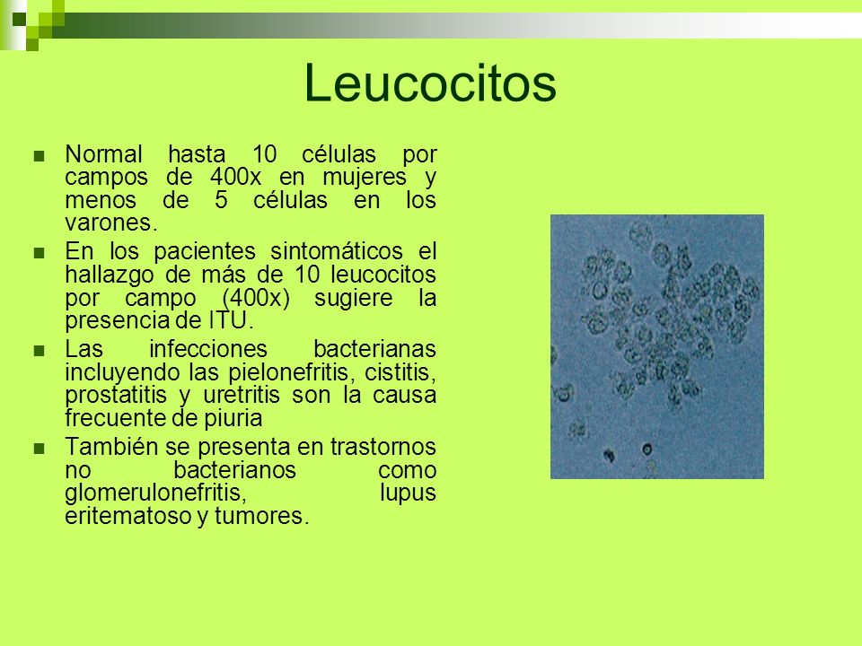 leucocitos de 12 a 15 por campo en orina